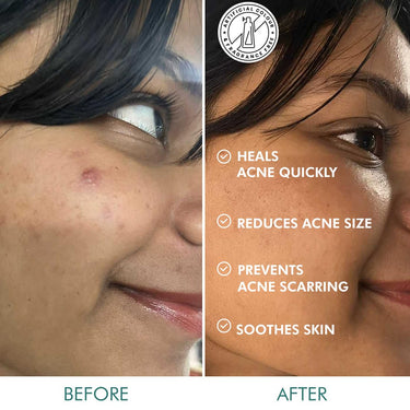 mCaffeine Matcha Tea Hydrocolloid Acne Patches with 0.5% Salicylic Acid | Invisible Waterproof Patches for Active Acne & Pimples | Reduces Acne Size in 2 Uses | for both Women and Men | All Skin Types - 3 Sizes (24N x1)